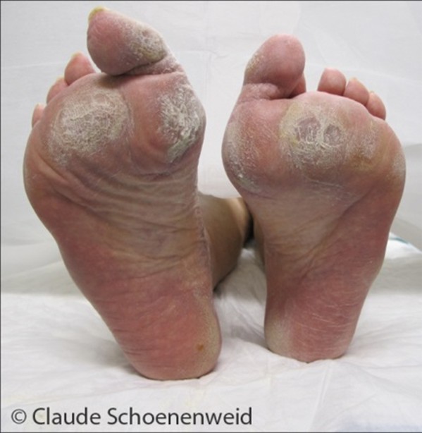 Hammer-/Krallenzehen